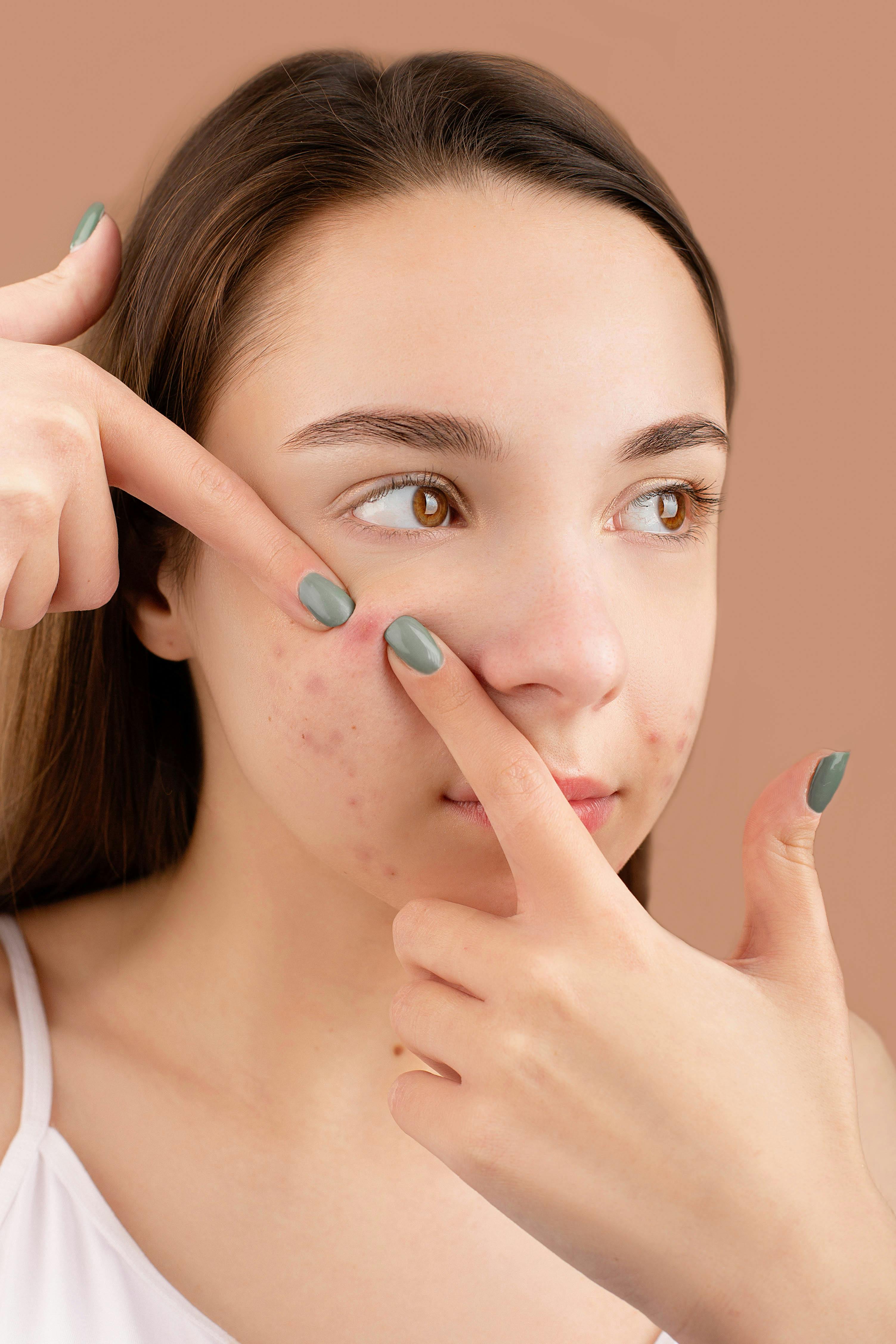Does Smoking Weed Cause Acne Breakouts?