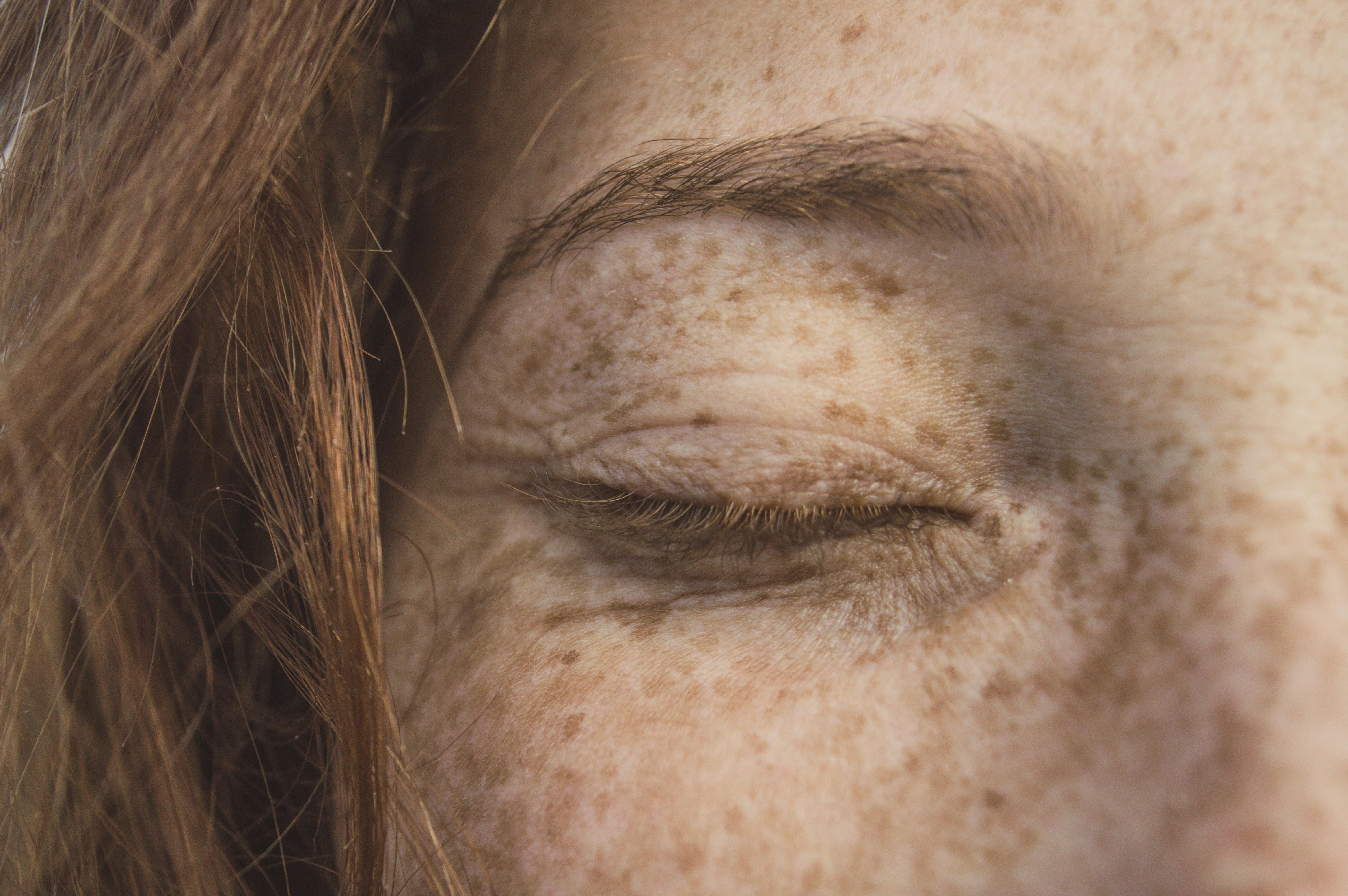 How to Get Rid of Freckles​?